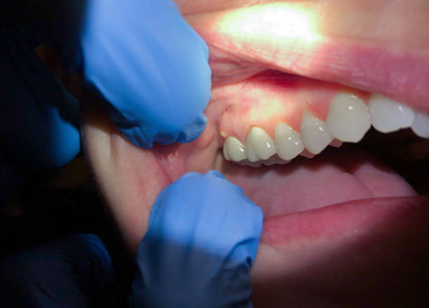 Best Emergency Dental Care for Broken or Chipped Teeth in Glennville, GA